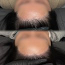 정헤어라인 - 26898 | 광주두피문신 여자 헤어라인 후기, 2년 전 모발이식을 받았음에도 두피문신을 받게 된 이유