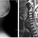 [디스크｜목디스크] - 목 디스크와 혼동하기 쉬운 증상들<4> 경추척수증 이미지