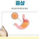 위산과다증상 원인 음식 치료 이미지