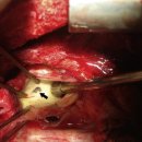 Ascending aortic pseudoaneurysm after aortic valve replacement: Watch the tip of the cardioplegia cannula 이미지