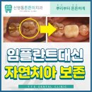 튼튼이치과의원 | [서천동 치과] 충치로 빠진 금니, 발치 대신 자연치아 살린 치료후기 - 신영통튼튼이치과