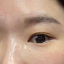 (주)잠실에너지 | 잠실피부과 다크서클 눈가주름으로 아이 써마지 시술 후기 통증 효과 가격