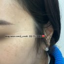 천안 두정역 인근 새살침 30년 전 패인 흉터 치료 1회 후기 (금액 &amp; 일자별 후기 사진 첨부)