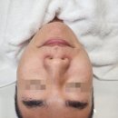 연메디칼 | [원주 여드름 피부관리] 원주 수분관리 원주 재생관리 세레누 내돈내산 마지막 4회차 후기