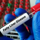 P-5F01 | 알티뮨 펨비듀타이드 2상성공 및 혁신치료제 지정 (f.DD01)