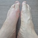 박달나무한의원 | 발에 체외충격파 치료 후 심각한 부작용! 한달 고생!