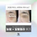 디파인피부과의원 | 압구정 이유클리닉 눈밑필러 및 앞볼필러 후기, 구체적인 개선 과정 공유