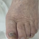 하나메디 | 대전 둔산동 발톱무좀 관리 까만발톱이 깨끗해졌어요~ 페디쿱스 동성풀리메디