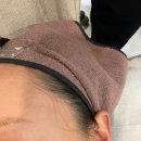 하얀마음한의원 | (대구 편평사마귀 무제한 제거 후기) 대구쥐젖,편평사마귀무제한 제거 한의원 후기