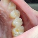 아이콘(icon)치과기공소 | 둔산동치과마다 충치치료 비용이 다른 이유? 아이콘레진부터 크라운까지 상세 가이드! 대전 아이콘레진...