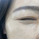 구디피부과 스킨부스터 콜라스터 효과 솔직후기