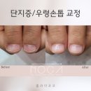 광주 엄지 손톱 우렁손톱 단지증 기르기 키우기 교정관리 노가인증샵