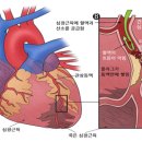 관상동맥질환(협심증.심근경색증) 이미지