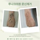 루나크의원 | 노원 문신제거 잘하는 루나크의원! 피코레이저 장점 5가지(후기, Q&amp;A, 주의사항)