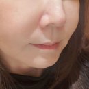 서울엘피부과의원 | 압구정 하오덤의원 주사염 치료 기록｜코 주변 붉은기로 피부과를 전전했던 시간