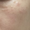 아로하뷰티 | 아로하피부과 피부는 좋아졌을까요?토닝관리 5회차: 루비레이저+미백관리 피부변화 기록 꾸준함💙