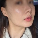 오푸스 | 신논현역 강남 피부과 아프지 않은 탄력 관리 오푸스레이저 후기