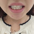 뉴엔투어 | 강남역 뉴엔치과 치아미백 관리 후기!