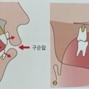 예동M치과의원 | [강일동 교정 소아치과] 만 7세 남아, 앞니 반대교합 근기능장치 치료후기입니다.(feat. 앞니가 거꾸로...