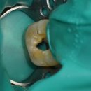 자모치과의원 | 때문에 썩은 사랑니 앞 치아 신경치료 C-shape 근관 바른사람치과 잠실치과 잠실역치과 잠실나루역치과