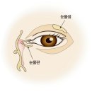 비루관 폐쇄[Nasolacrimal duct obstruction] 눈질환 이미지
