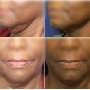 고려수지요법학회 | 수지구청피부과 울쎄라 볼꺼짐 걱정된다면 '이것' 먼저 체크하세요