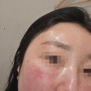 명동 한의원 추천 서울 편평사마귀 성지 + 무제한 제거 내돈내산후기
