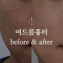 송파새살침 볼여드름흉터(acne scar) 치료사례