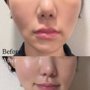 올케어성형외과의원 | 신사역 올타이트리프팅 후기｜왜 착붙 리프팅이라고 하는지 알겠더라
