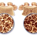 노인 되면 급증하는 골다공증, 뼈 건강이 위험하다 이미지
