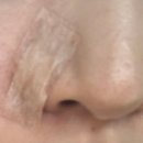 하나성형외과의원 | [신사 표피낭종 성형외과의원] 표피낭종 수술 후기 &#34;오체안 성형외과의원 신사&#34;