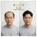 의왕가발, 정수리 탈모 고민 끝! 실패 없는 남자 맞춤가발 가격 및 후기