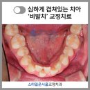 여의도이치과의원 | 비발치 교정 과정, 비용, 방법, 후기 총정리 - 서울 비발치교정 전문 치과