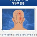 오른쪽 뒷머리 통증 원인 대처방법 이미지