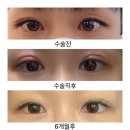 에이엠성형외과의원 | 쌍꺼풀 재수술 6개월 후 모습!! 수술전, 후, 현재 눈 사진 공개🔥
