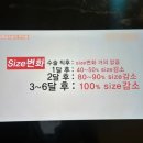 멍꿀잠 | 배지방흡입가격 인천다이어트병원 당일~2일차 후기 사진많음 (멍,붓기,통증)