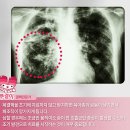 질병 "폐결핵 Pulmonary tuberculosis" 이미지