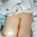 개복당 | 난소암 세로개복 수술 흉터 관리 1년 후기