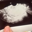 자담한방병원 | 자연임신 한방에 성공한 후기:) 오잉 내가 임신이라구?