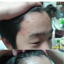 이바인화장품 | 이바인화장품 체험후기 - 중2아들 여드름 관리
