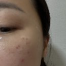 백구한의원 | 부산 편평사마귀 제거 치료 잘하는 곳, 백개 제거 후기