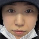 절골 | 강남코성형외과, 코수술 후기. 절골, 귀연골, 코끝, 비중격연골 [당일~3일차]