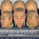 차이헤어 - 여수시 웅천로 90 | 부산두피문신 잘하는곳 정수리 헤어라인 전후 차이 후기