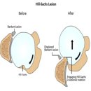 추적 60병 | 방카르트 병변(Bankart lesion), 관절경 방카르트 병변 봉합술(Arthroscopic bankart repair)