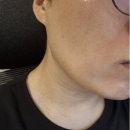 루카스 | 얼굴이 까만 이유가 홍조? 엑셀브이, 루카스 제네시스 레이저 피부과 내돈내산 후기