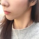 더블에이의원 | 옥수역피부과에서 더블로골드리프팅하고 왔어요