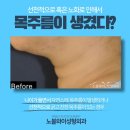 노블외과의원 네이버블로그