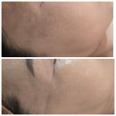 천안 잡티제거 20년 경력 원장님의 수기 케어 받아본 리얼후기