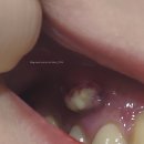 카세파 | 🦷임플란트 후기_(1)🦷