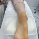 레푸스 구월점 내성발톱 무좀발톱 발각질 문제성발 이미지